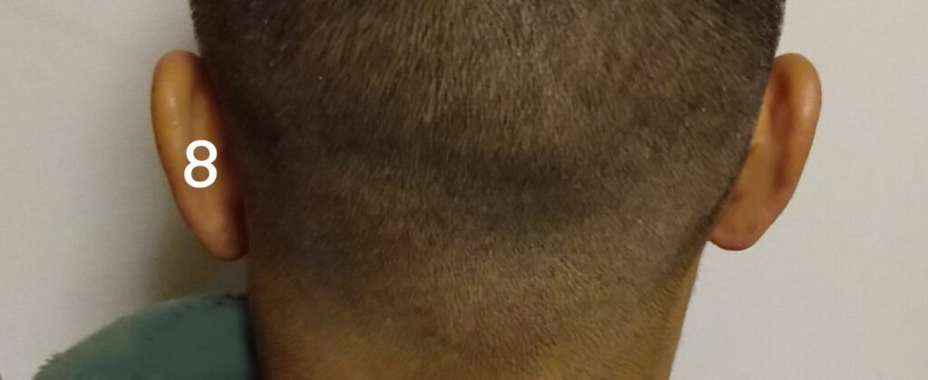 バリカン8ミリ後頭部の画像
